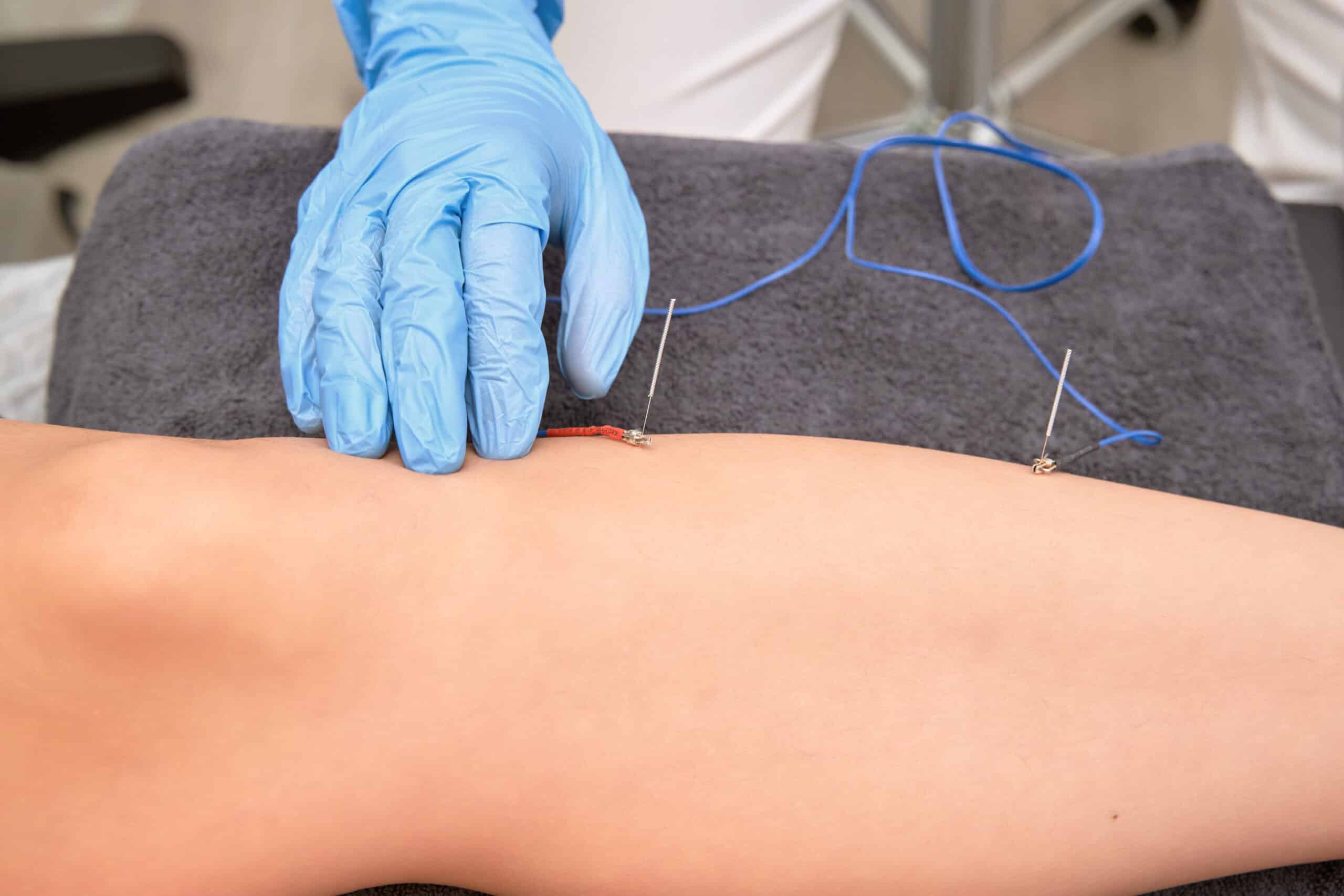 Dry Needling and IMS Therapy in Edmonton